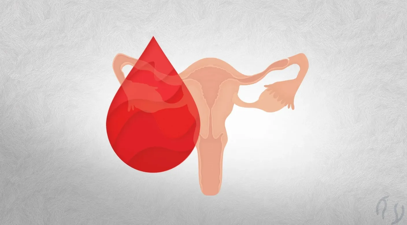 Sangramento uterino anormal